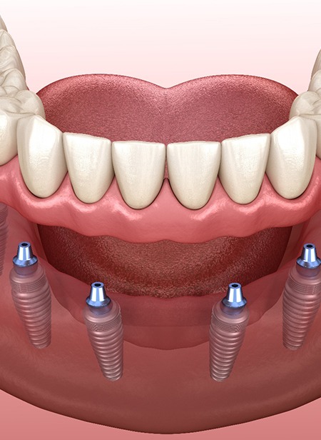 Diagram of an implant denture in Manchester