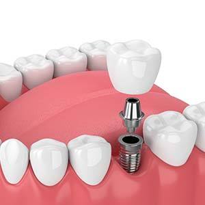 Diagram showing single tooth dental implant in Manchester