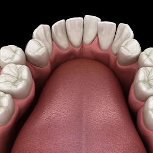 Illustration of crooked teeth