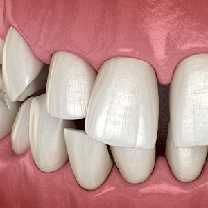 Illustration of gapped teeth