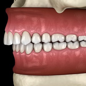 Illustration of an overbite
