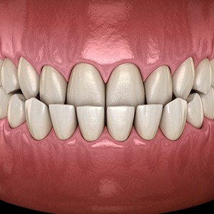 Illustration of an underbite