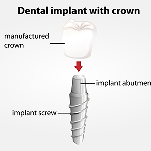 dental implant illustration that shows abutment 