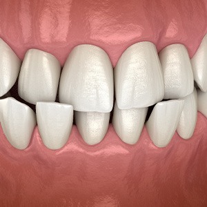 Illustration of a crossbite