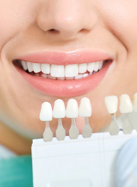 Patient's smile compared with veneer shade chart during cosmetic dentistry