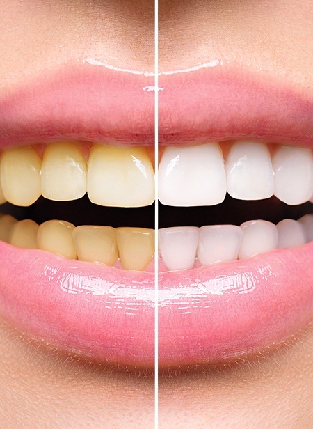 Smile before and after teeth whitening