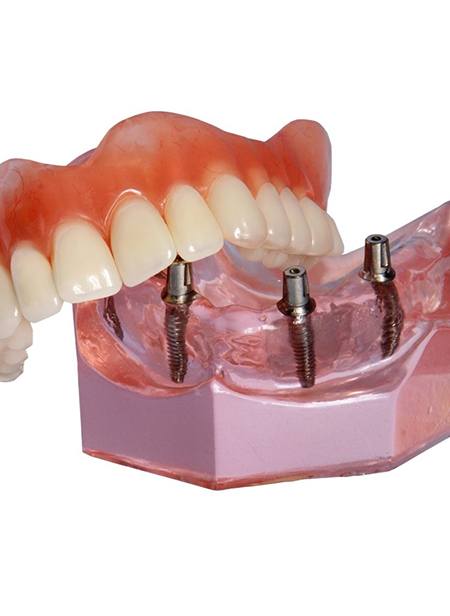A customized denture resting on top of a mouth mold that contains four dental implants