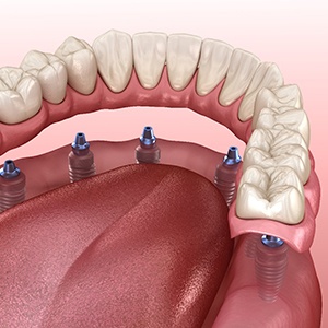 3D image of implant dentures in Manchester