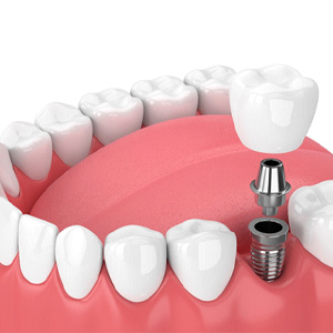 closeup of dental implant in Manchester