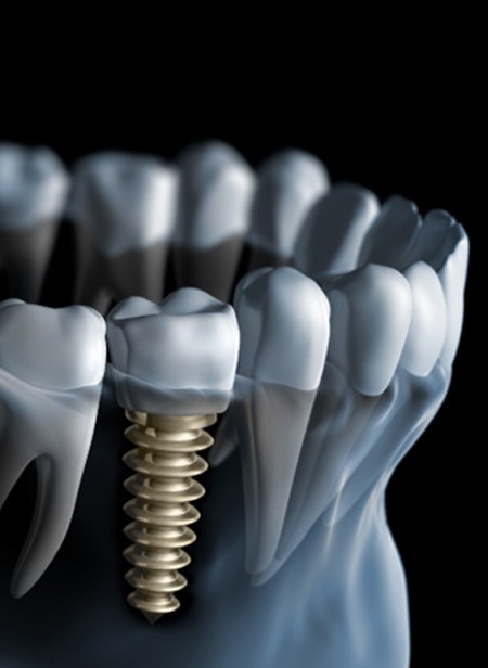 Digital illustration of dental implant