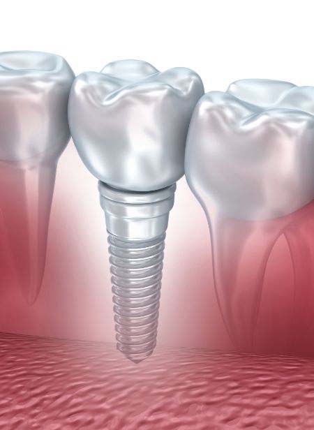 Closeup of a diagram of dental implants in Manchester