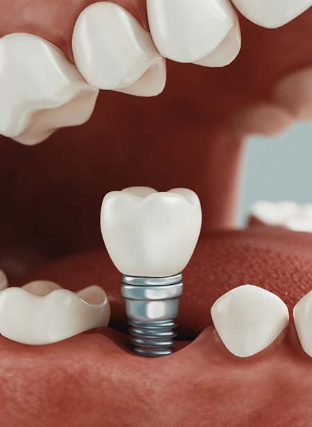 Diagram showing the process of getting dental implants in Manchester