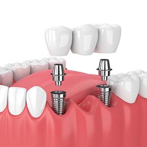 Diagram showing implant bridge replacing multiple missing teeth in Manchester