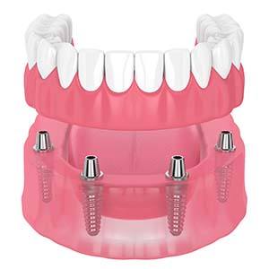 Diagram showing implant denture in Manchester