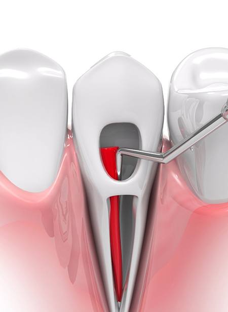 Illustration of root canal therapy in Manchester, NH