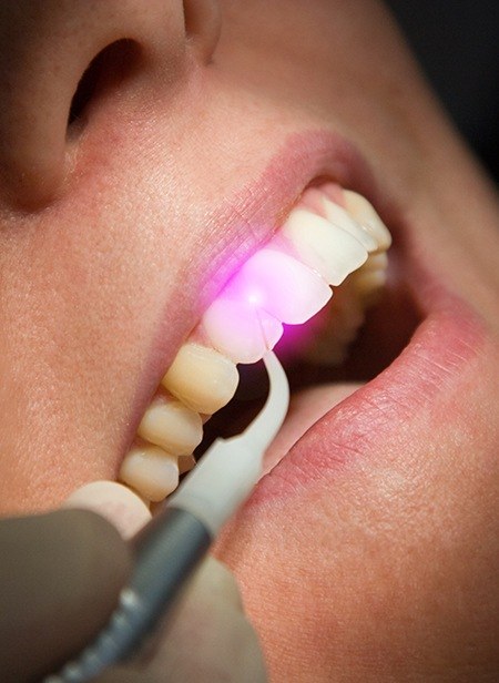 Patient receiving soft tissue laser dentistry