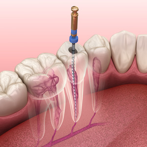 Illustration of root canal therapy in lower arch