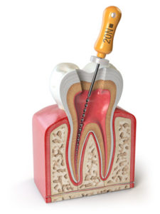 Model of root canal therapy being performed