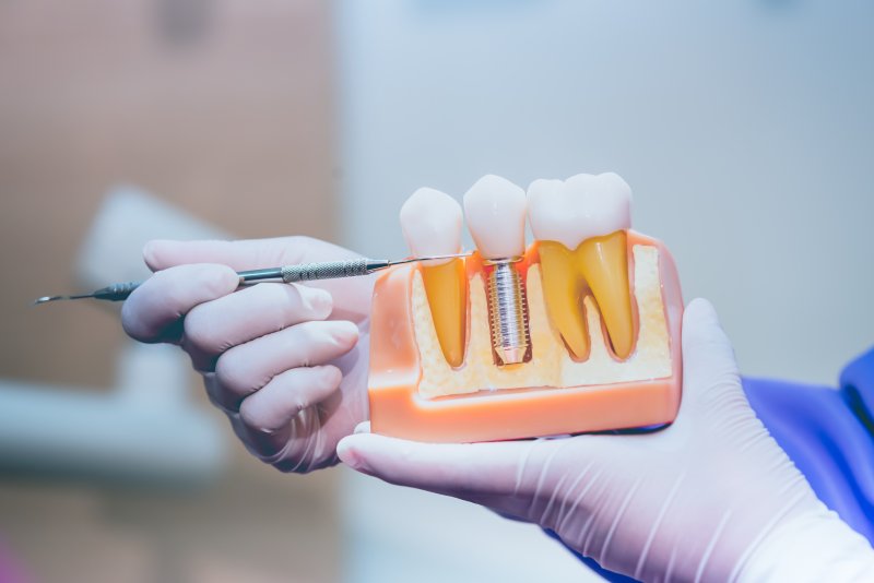 A dentist explains how dental implants work