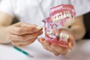 Dentist holding model while explaining dental implants