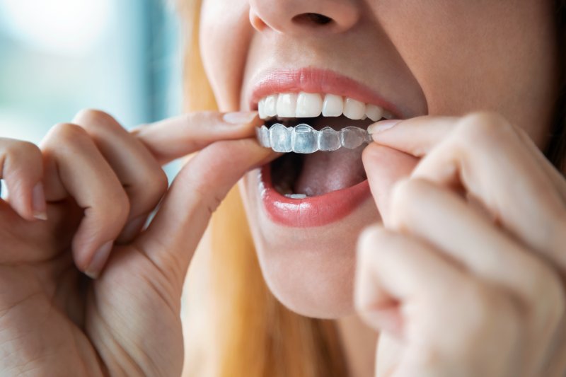 A woman placing an Invisalign aligner over her teeth
