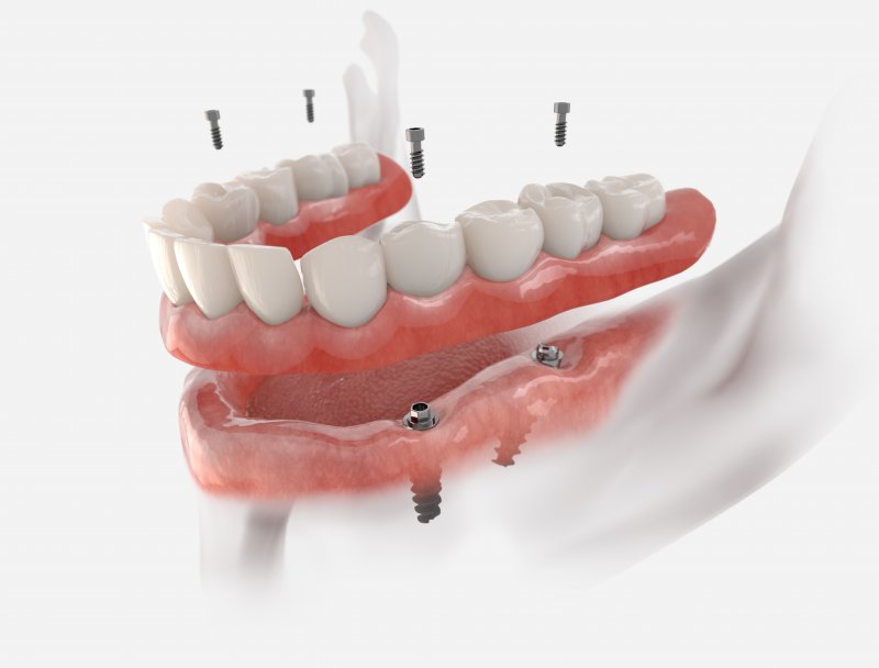 A 3D illustration of an implant denture